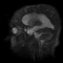 ProjectionMaxVentricles
